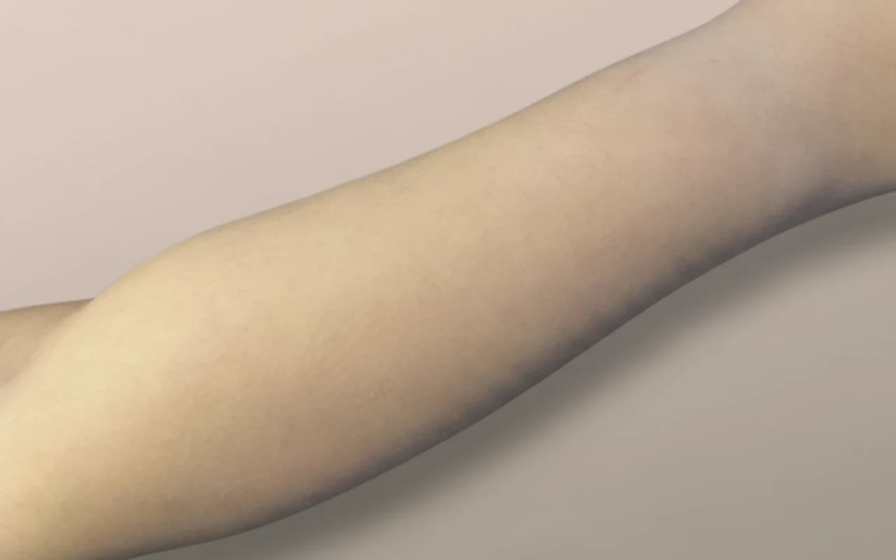 R. — na Laserontharing