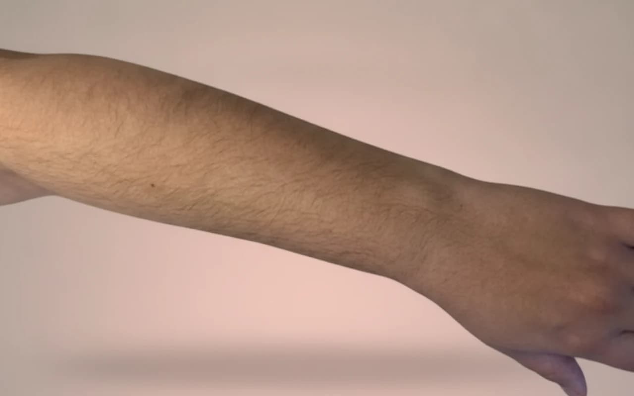 R. — voor Laserontharing